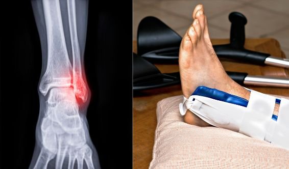 Rééducation fracture cheville à domicile Rabat Salé Témara