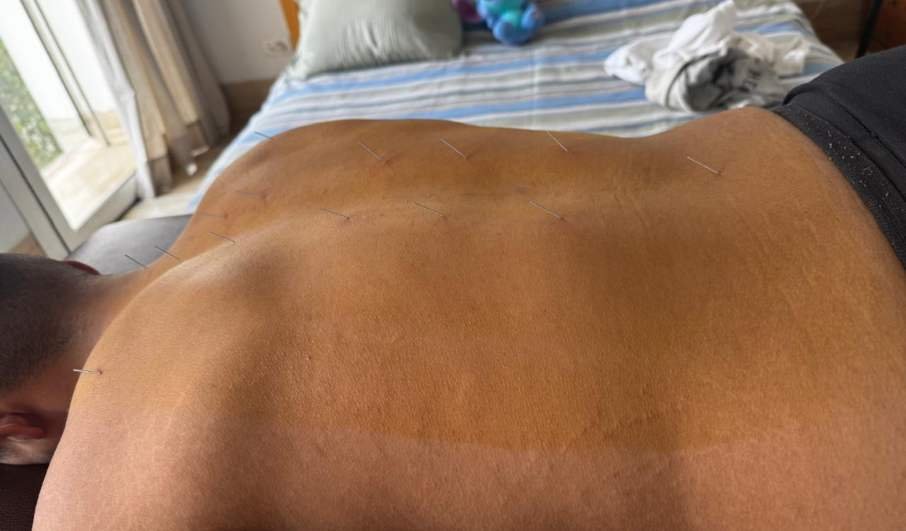 Préparation du dos avant séance d’acupuncture à domicile