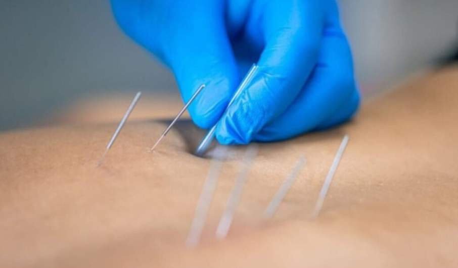 Pose d’aiguilles pour acupuncture à domicile