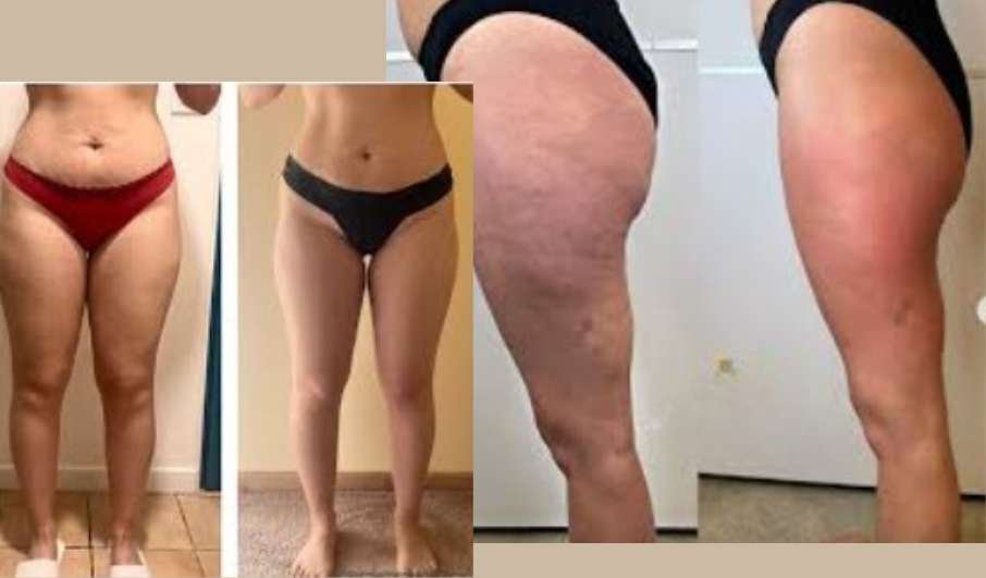 Drainage lymphatique pour jambes lourdes et cellulite à domicile au Maroc