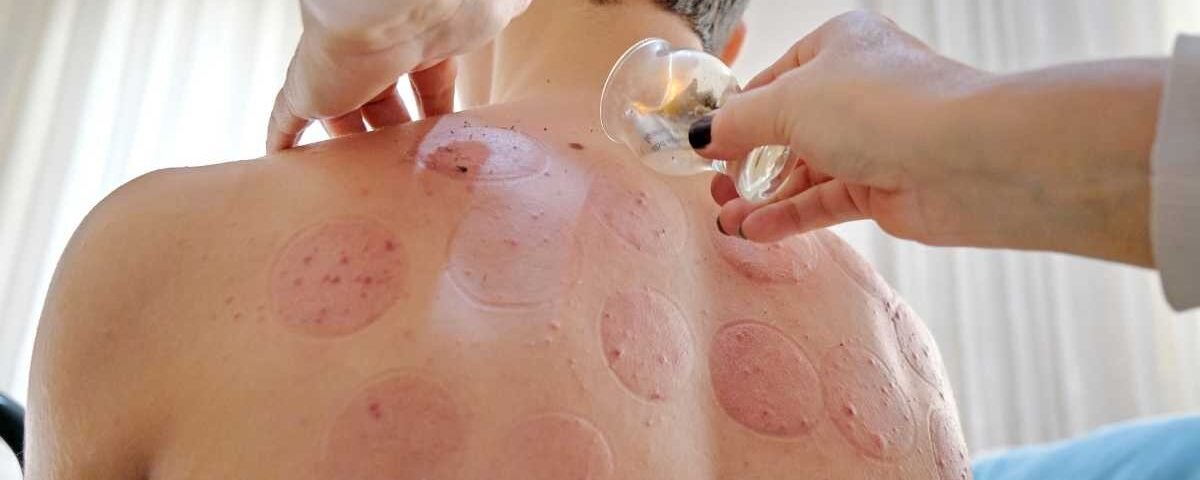 Est-ce que combiner hijama et kinésithérapie est efficace