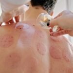 Est-ce que combiner hijama et kinésithérapie est efficace