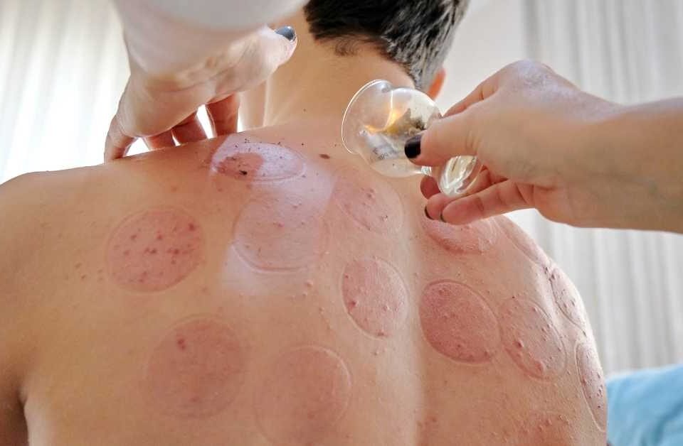 Est-ce que combiner hijama et kinésithérapie est efficace