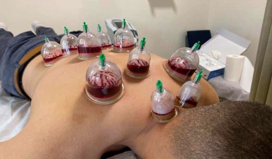 Hijama humide à domicile