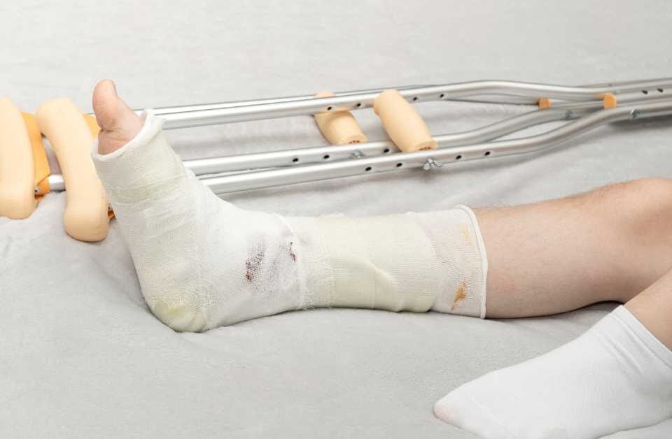 Quand reprendre l'appui après une fracture de cheville avec la kiné